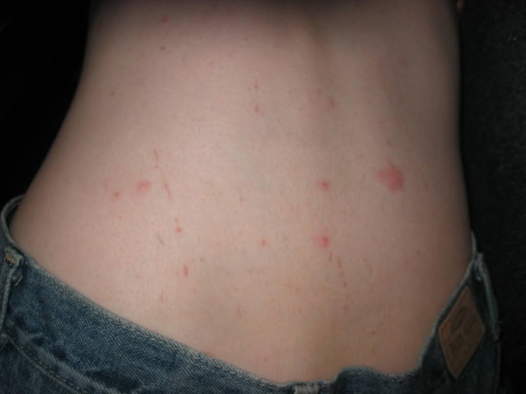 But then I found this guy, he was 22 and wrote poetry about me! I gained all of my to-date sexual experience with a male in the space of 2 hours in the woods somewhere in Alaska with that guy (photographic evidence of the mosquito bites-scratches below)