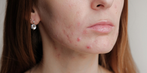 rcgp's tweet photo. Would you like to learn more about #acne vulgaris? As one of the most common skin conditions in the UK, it leads to 3.5 million primary care visits in a typical year. Access our new Essential Knowledge Update for more information: https://t.co/LwAL320Fvw #GPCPD #GPLearning https://t.co/9nQQ6SrBAC