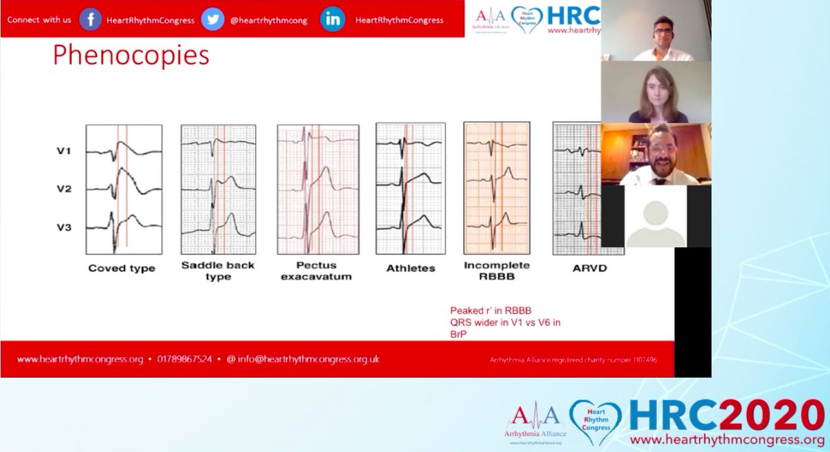 Nikhil_Ahl's tweet photo. We were lucky to have @LambiasePier speaking in the Trainee session of @heartrhythmcong on inherited arrhythmia syndromes. 🙏 a 30 min refresher available to all #epeeps registered for #HRC2020. Also great for any @theBJCA trainee who may be revising for the #EEGC #KBA exam 🤓 https://t.co/dUQYqvoF2o