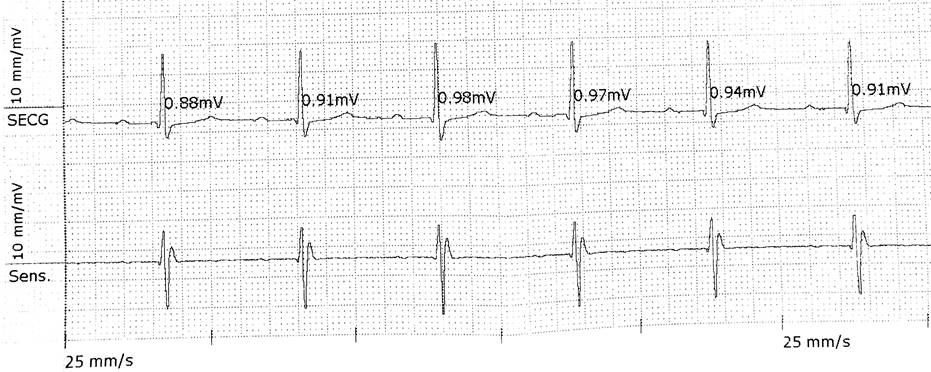 Biotronik_UK's tweet photo. If you missed our live webinar last week on "Implantable Cardiac Monitor of 2020: P wave visibility AND 99% noise free? Review of #BMIII" head over to @heartrhythmcong to register so you're ready to watch again.
#heartrhythmcongress ##cardiacmonitor #ICM #arrhythmia #syncope https://t.co/KI9c1Ll9Pg