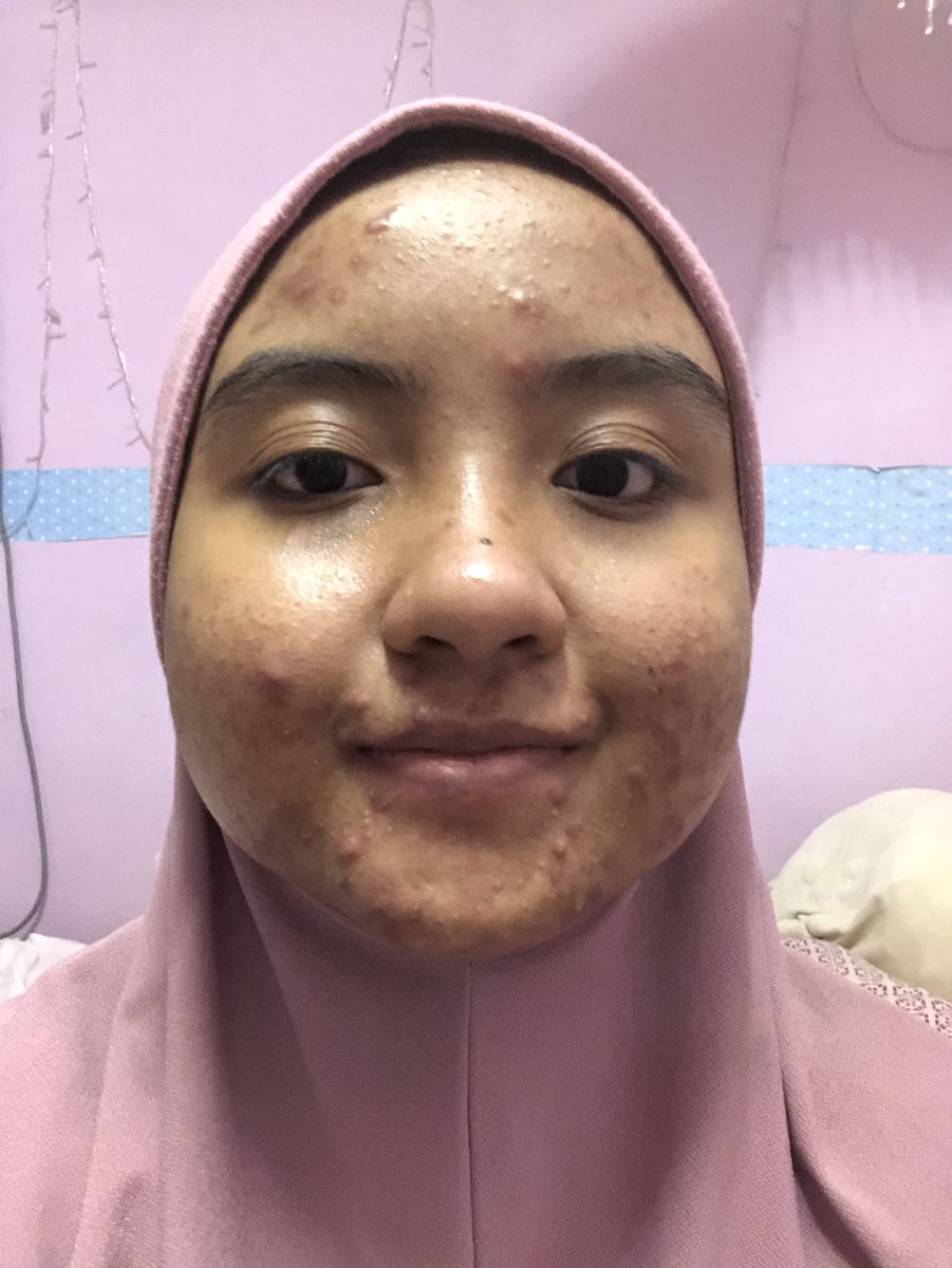 First, here is my before and after (both bare face and after is petang tadi lol) I have all you can list hahaha bumps, acne, scars and even hyperpigmentationI am not yet flawless but the doctor said i am making great progress and i just need to be patient with the scars.