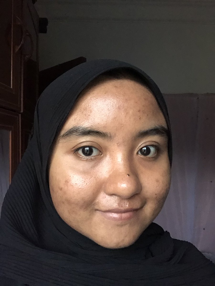 First, here is my before and after (both bare face and after is petang tadi lol) I have all you can list hahaha bumps, acne, scars and even hyperpigmentationI am not yet flawless but the doctor said i am making great progress and i just need to be patient with the scars.