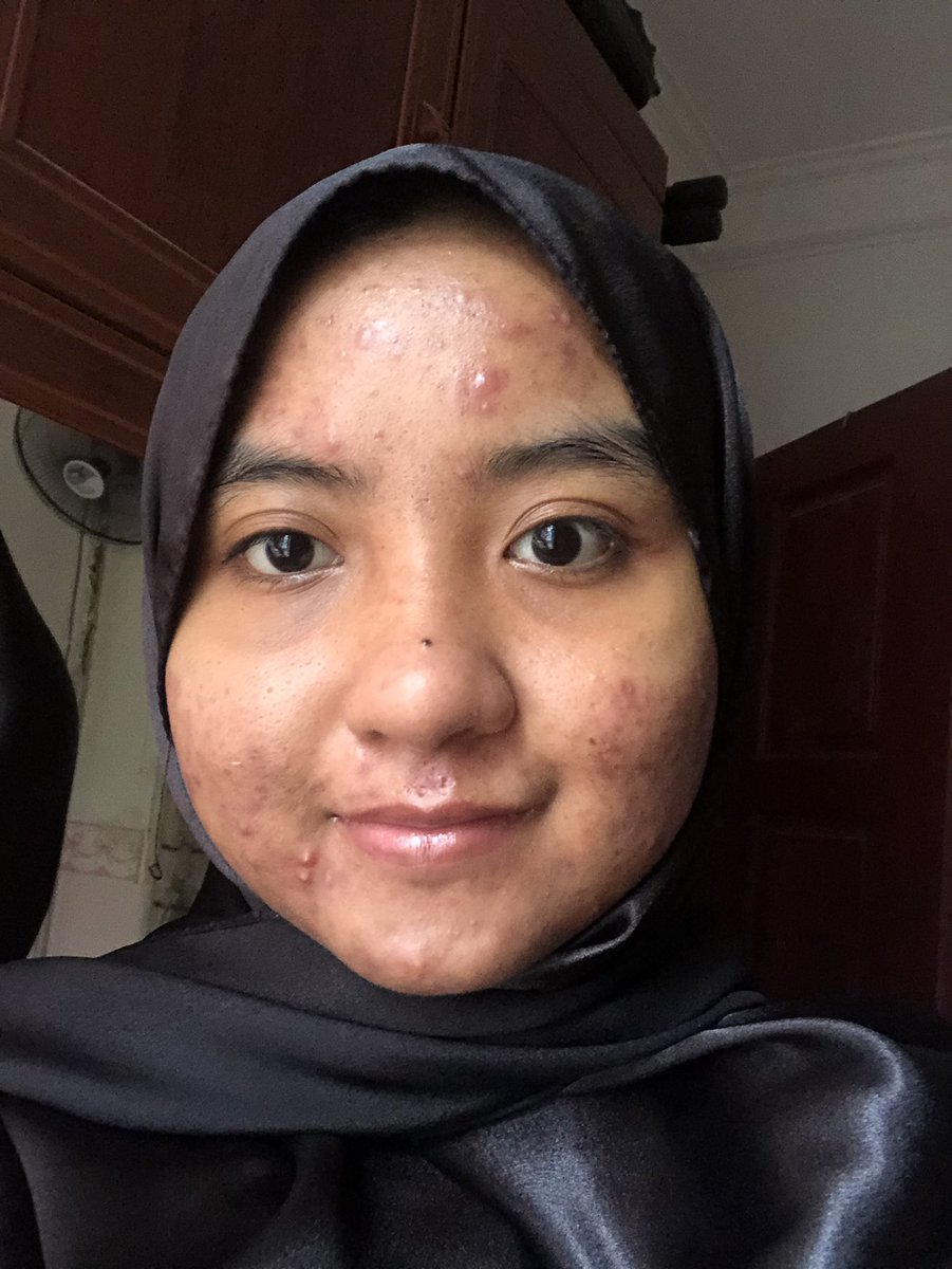 3. Proceed to gov hosp on your appointment date! Excited kan! This is my face masa first day tu haha malu nak jumpa doktor. Then the doctor gave me additional stuffs(aside from xidox and the lotion) I’ll explain in next tweet