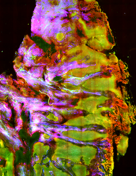 LFV_HealthTech's tweet photo. At #BMT2020 @DGBMT tomorrow: Orlando Guntinas-Lichius @UKJ_Jena will present how #biophotonics (for example from @Leibniz_IPHT) could improve medical #imaging for head and neck surgeries. | @LeibnizWGL https://t.co/h25WToqBcO