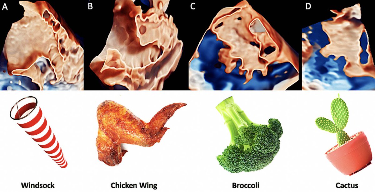 Visualization of the left atrial appendage will never be the same! My #NaughtyFellow found a windsock, a chicken wing, broccoli, and cactus in the LAA space! Transillumination and transparency is the way to go. No need for CT! #EchoFirst 

Read more here: onlinejase.com/article/S0894-…