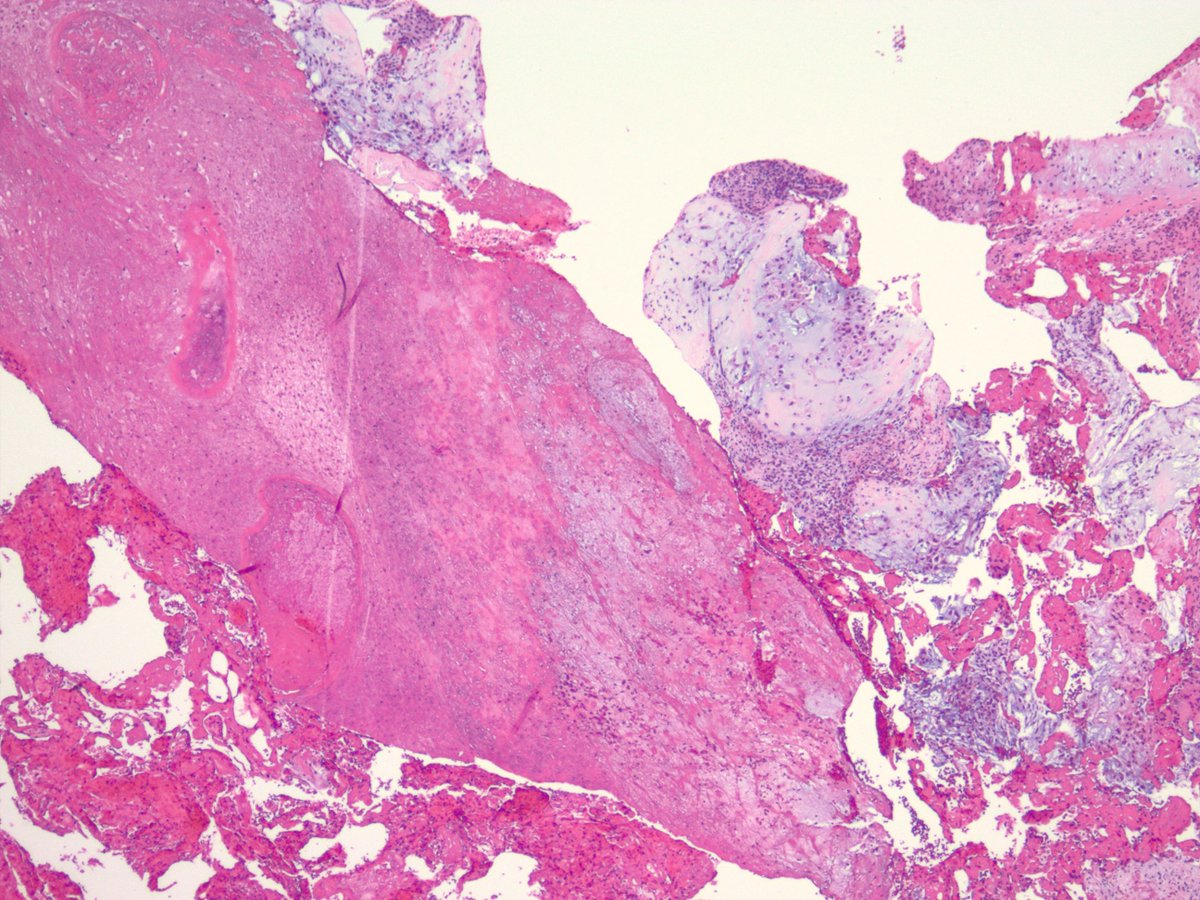 Tumor from my slide collection (not giving site) - DDX/IHC? <a href="/smlungpathguy/">Sanjay Mukhopadhyay</a> <a href="/ScottBikeethan/">Scott Kilpatrick, MD</a> <a href="/AbabnehEmad/">Emad Ababneh</a> <a href="/RDWhaleyMD/">Rumeal D. Whaley, MD</a> <a href="/DrKathyAP/">Kathy Allen-Proctor</a> #PathTwitter #entpath
