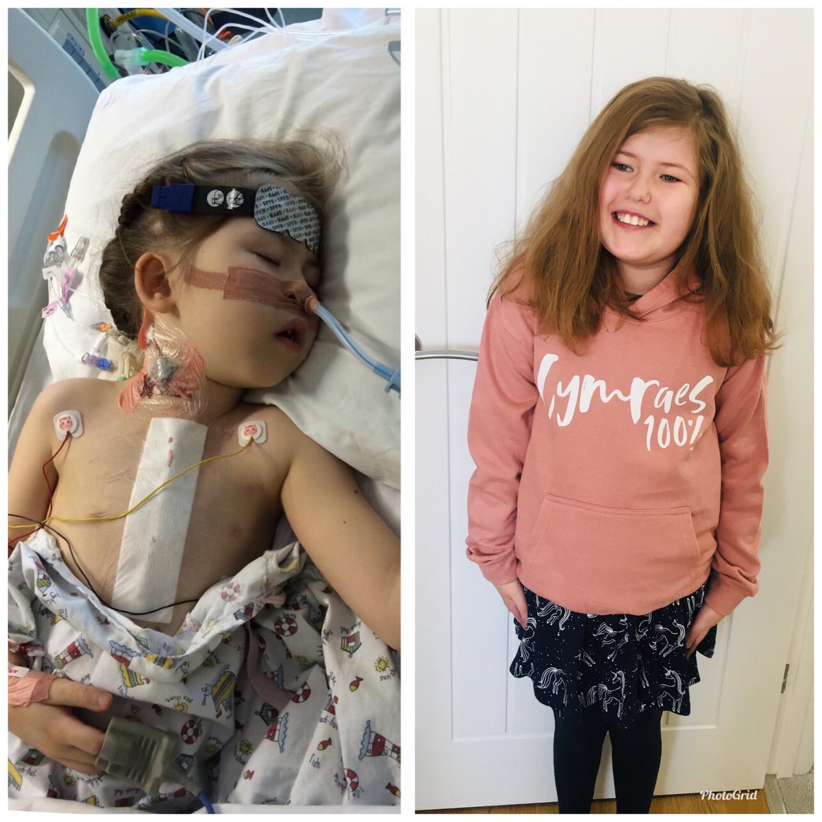 ApelElain's tweet photo. Happy #worldheartday2020 to our beautiful brave Elain ❤️
We are so proud of how hard you have fought to be here and the incredible young woman you have become ✨
#chd #pulmonaryatresia #vsd #mapcas #surgery #heartsurgery #1in100 #22qtie #22q #digeorgesyndrome #warrior https://t.co/PrE6vwLng1