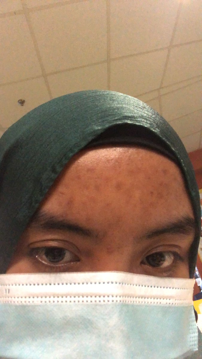 3) how i get rid of tiny bumps yang berlambak! DOUBLE CLEANSING! Before this i doublecleanse pakai cleansing oil then pencuci muka but it does not work for me  bumps ada je!Then i changed to micellar water+face wash and tadaaaa! Takde bumps! Just scars hehe