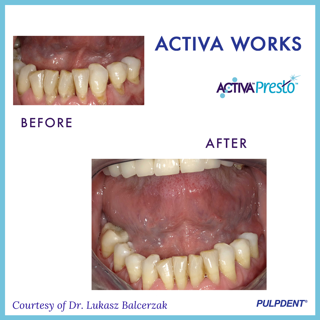 PulpdenTweets's tweet photo. Dr. Lukasz Balcerzak shared these clinical images with us after using our newest restorative material, ACTIVA Presto. 🦷✔️ Email your case images to 📧: feedback@pulpdent.com #ACTIVAWORKS #ACTIVAPresto #Pulpdent #PulpdentCorporation #Dentist #DentalHealth #Dental #DentalStudent https://t.co/hfS4MJYGjr