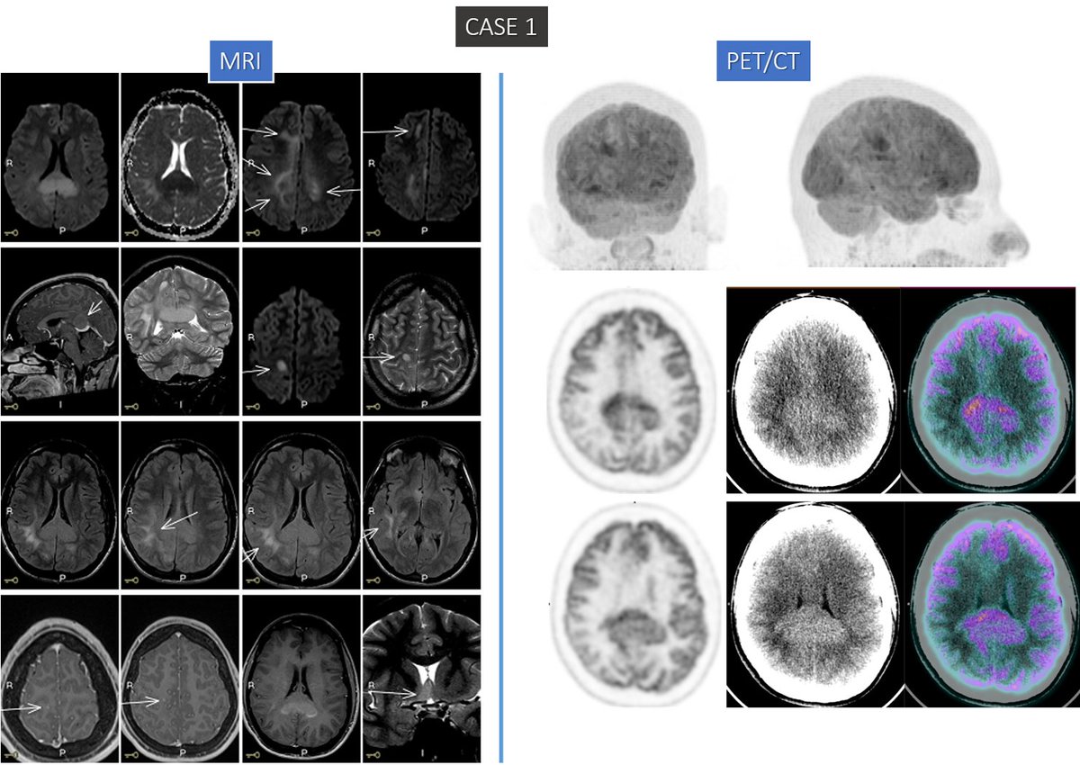 CASE 1: 22 YO male pt w/ dizziness and headache;
🔍MRI: Lesions in splenium of corpus callosum, bilateral frontoparietal &amp; centrum semioval w/ ↑signal on T2wi/FLAIR, ↓signal on T1wi &amp; restricted diffusion on DWI w/ mild peripheral contrast enhancement. PET shown in the picture.