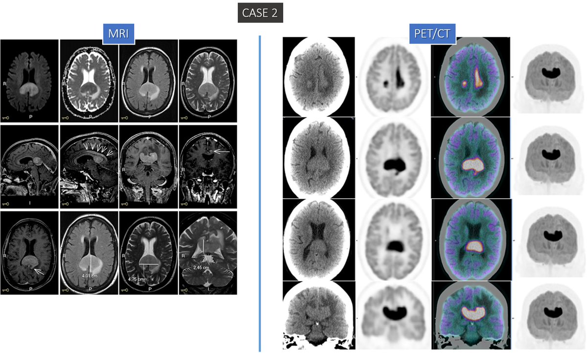 CASE 2: 68 YO female pt w/ memory deficit, confusion &amp; gait disturbance;
🔍MRI: Lesion in splenium of corpus callosum w/ ↑signal on T2wi/FLAIR, ↓signal on T1wi &amp; restricted diffusion on DWI w/ intense contrast enhancement, surrounded by vasogenic edema. PET shown.
