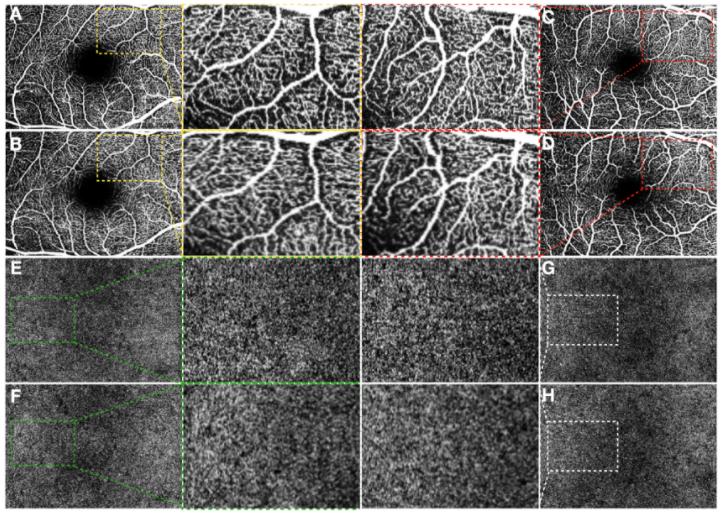 ARVOtvst's tweet photo. Just published in @ARVOtvst: "Comparison and Repeatability of High Resolution and High Speed Scans from #Spectralis #OCTA."
Free article here: https://t.co/ikAL19Xgtg @DohenyEye #UniversityofMilan #retina #OCT https://t.co/P0WufJBp1j