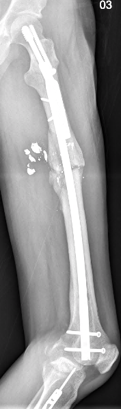 COVID happened and missed some follow-ups but here's 4.5mo out. 3/4 cortices healed in the femur. Full WB, no pain. (7/-)