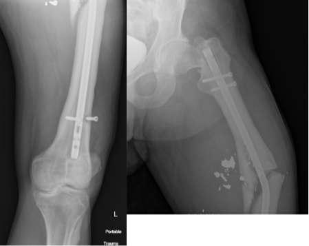 A special kind of neck-shaft combo. Healed an old GSW femur, but only after auto-dynamizing, then presented with this injury several years later after a high speed MCC. (1/-)
