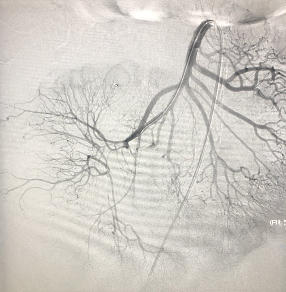 pparmetIR's tweet photo. 56 yo M w/ 6 hrs worsening 10/10 abd pain. CTA shows acute arterial thrombosis of SMA branches, large eccentric plaque proximally.

Early dx and #withoutascalpel intervention by #IRad to reperfuse threatened bowel, fix inflow, and avoid extensive bowel resection. @SIRRFS @SIR_ECS https://t.co/4mXJ5UZ2yq
