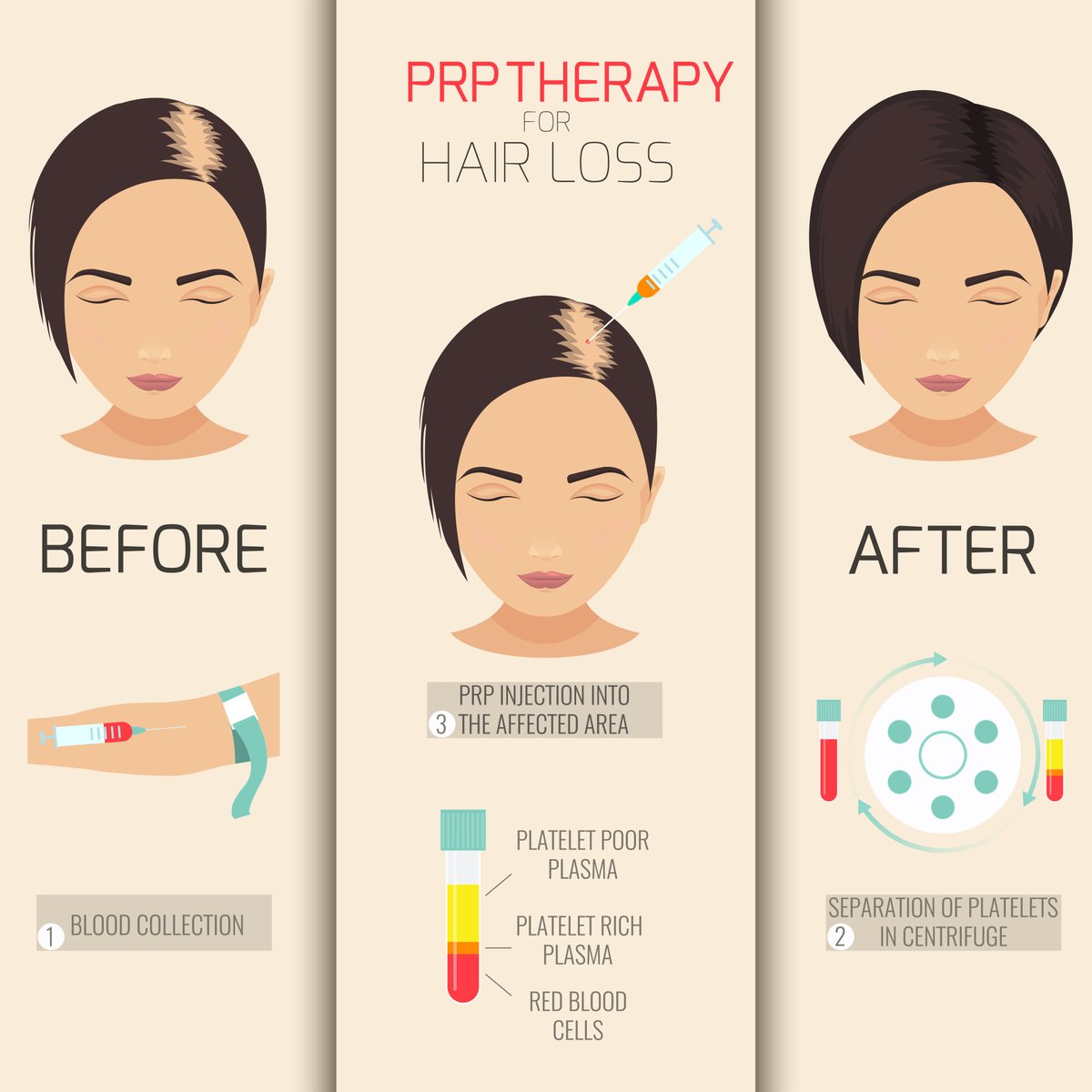 PRP HAIR RESTORATION💇🏻‍♀️  a non-surgical treatment that utilizes your body’s own platelet rich plasma (PRP) to help restore hair for pattern hair loss or if you are experiencing thinning hair of the scalp.

Pure Medical Aesthetics 
emma@puremedicalaesthetics.com 
203.253.0351