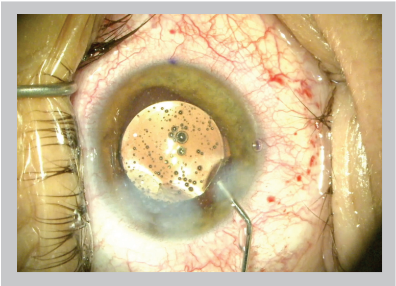 OphthTimes's tweet photo. Perioperative medications can eliminate postoperative drops after cataract surgery
https://t.co/95tP67WU2O https://t.co/d7rNB6OzuH