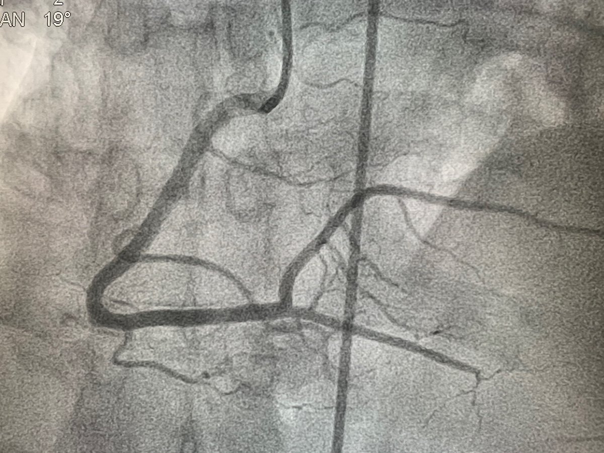 Jorge Nuche (@jorgenuche) on Twitter photo Seguimos atendiendo infartos 24/7 en <a href="/hospital12Oct/">Hospital 12 Octubre</a> ¡El 🦠no nos para! <a href="/SUMMA112madrid/">SUMMA112</a> <a href="/Hemodinamica12O/">HemodinamicaH12O</a> <a href="/igomezblazquez/">Iván Gómez Blázquez</a> <a href="/shci_sec/">ACI-SEC: Hemodinamica</a> <a href="/PilarNotario1/">Pilar Notario</a> Seguimos atendiendo infartos 24/7 en <a href="/hospital12Oct/">Hospital 12 Octubre</a> ¡El 🦠no nos para! <a href="/SUMMA112madrid/">SUMMA112</a> <a href="/Hemodinamica12O/">HemodinamicaH12O</a> <a href="/igomezblazquez/">Iván Gómez Blázquez</a> <a href="/shci_sec/">ACI-SEC: Hemodinamica</a> <a href="/PilarNotario1/">Pilar Notario</a>