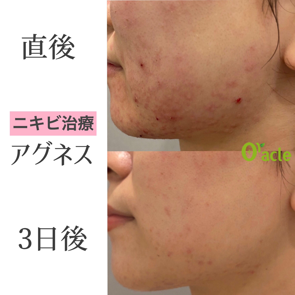 チーフ しゃがむ 人質 顔 半分 ニキビ Kegahaeru Jp チーフ しゃがむ 人質 顔 半分 ニキビ Kegahaeru Jp
