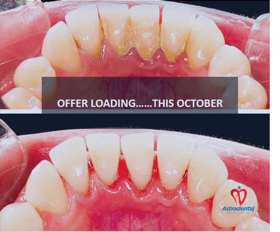 Name of Procedure:  𝘚𝘤𝘢𝘭𝘪𝘯𝘨 &amp; 𝘗𝘰𝘭𝘪𝘴𝘩𝘪𝘯𝘨
Description:  𝘈 𝘵𝘺𝘱𝘦 𝘰𝘧 𝘥𝘦𝘯𝘵𝘢𝘭 𝘤𝘭𝘦𝘢𝘯𝘪𝘯𝘨 𝘵𝘩𝘢𝘵 𝘳𝘦𝘢𝘤𝘩𝘦𝘴 𝘣𝘦𝘭𝘰𝘸 𝘵𝘩𝘦 𝘨𝘶𝘮𝘭𝘪𝘯𝘦 𝘵𝘰 𝘳𝘦𝘮𝘰𝘷𝘦 𝘱𝘭𝘢𝘲𝘶𝘦 𝘣𝘶𝘪𝘭𝘥𝘶𝘱.
Benefits: 𝘗𝘳𝘦𝘷𝘦𝘯𝘵 𝘎𝘶𝘮 𝘋𝘪𝘴𝘦𝘢𝘴𝘦