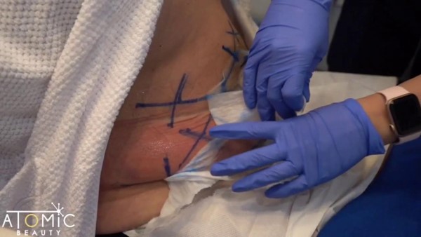 Curious about #coolsculpting?❄️
Watch an #atomicbeauty <a href="/CoolSculpting/">CoolSculpting</a> treatment in action!⬆️

Book a complimentary consultation for this treatment today:
💲Starting at $599+
📍#Frisco, Texas⁣
📲(469) 213-3086⁣
🌏

atomicbeauty.com 

#theatomicbeauty #friscomedspa