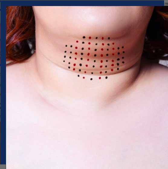 Kybella is an injectable treatment for reducing fat on the upper neck. It’s made up of a natural occurring substance in the body called deoxycholic acid, which breaks down fat cells. Eliminate stubborn areas where fat accumulates like the jawline and under the chin permanently!