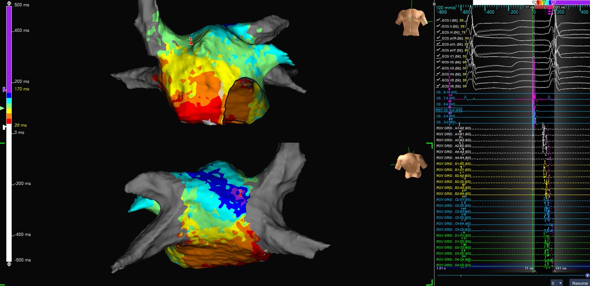 subparsonsmaps's tweet image. Great case with Dr. V at @SelfRegional. Patient had a prior PVI and had multiple documented atypical flutters. We made a quick ILAM map with #HDGrid before mapping these two beauties. @sheilapressley7 @AbbottCardio #mapmoreburnless