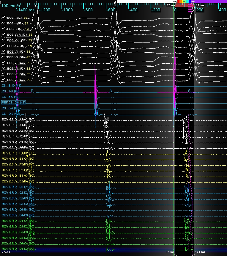 subparsonsmaps's tweet image. Great case with Dr. V at @SelfRegional. Patient had a prior PVI and had multiple documented atypical flutters. We made a quick ILAM map with #HDGrid before mapping these two beauties. @sheilapressley7 @AbbottCardio #mapmoreburnless