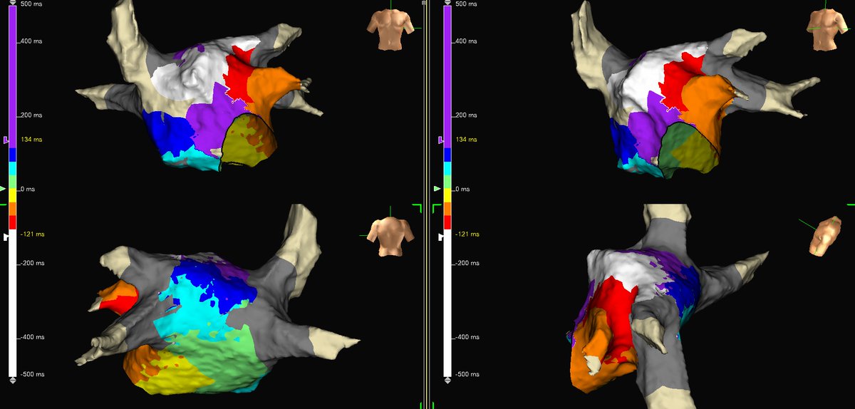 subparsonsmaps's tweet image. Great case with Dr. V at @SelfRegional. Patient had a prior PVI and had multiple documented atypical flutters. We made a quick ILAM map with #HDGrid before mapping these two beauties. @sheilapressley7 @AbbottCardio #mapmoreburnless