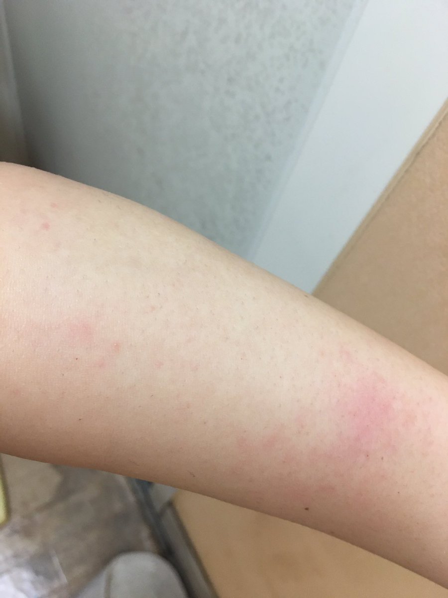 Rio 犬系女子 耐える 疲労感きつい ムーモで脱毛した トゥルトゥル 脇毛はやってないけど腕と足は脱毛した 女の子って大変なのよ 赤いのは肌荒れじゃなくてもやしすぎて赤く見えてるだけです Rio 犬系女子 耐える 疲労感きつい ムーモで脱毛した トゥルトゥル 脇毛はやってないけど腕と足は脱毛した 女の子って大変なのよ 赤いのは肌荒れじゃなくてもやしすぎて赤く見えてるだけです