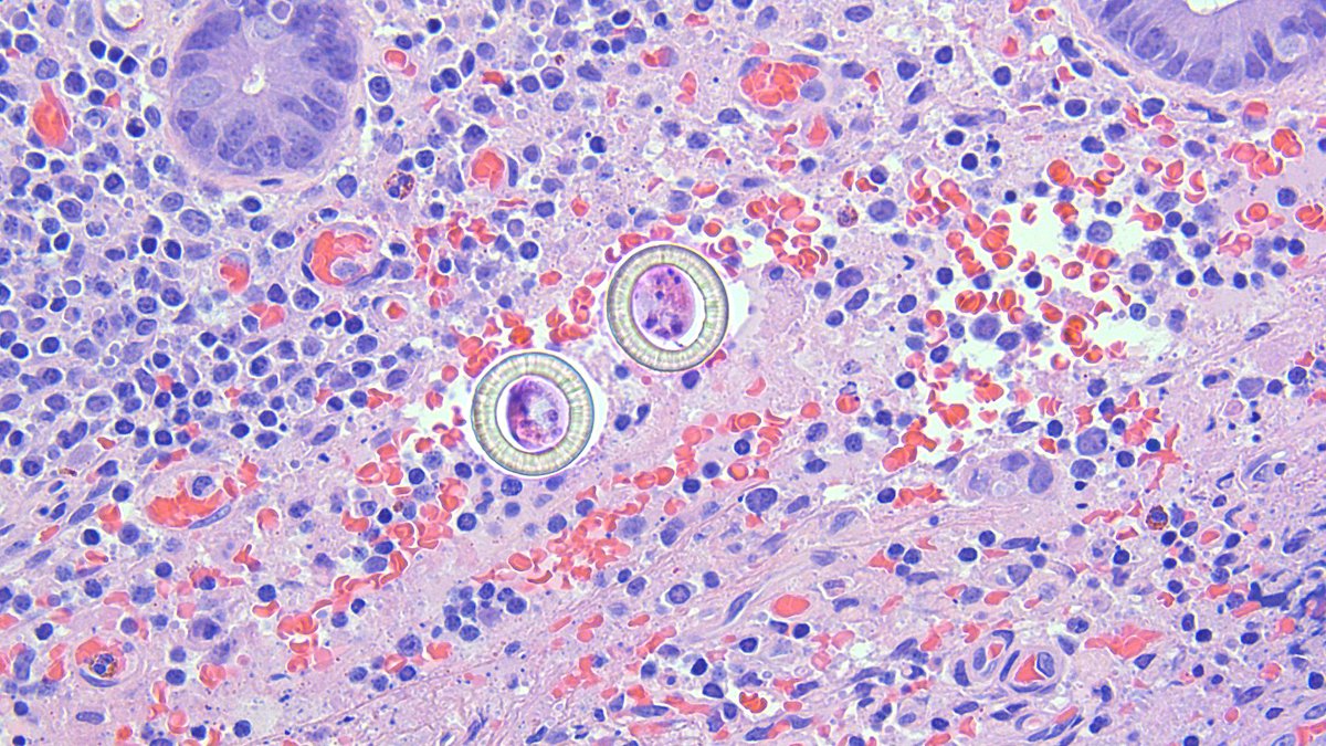 ParasiteGal's tweet image. The Parasite Case of the Week 608 is up – Eggs found in the intestine – what are they?  See the case here: parasitewonders.blogspot.com/2020/09/case-o… #asmclinmicro #MayoClinMicro #mayopath #parasites #pathology @JMGardnerMD @mayocliniclabs @ASTMH @Pathologists @AmSocParasit @LSHTM #path2path