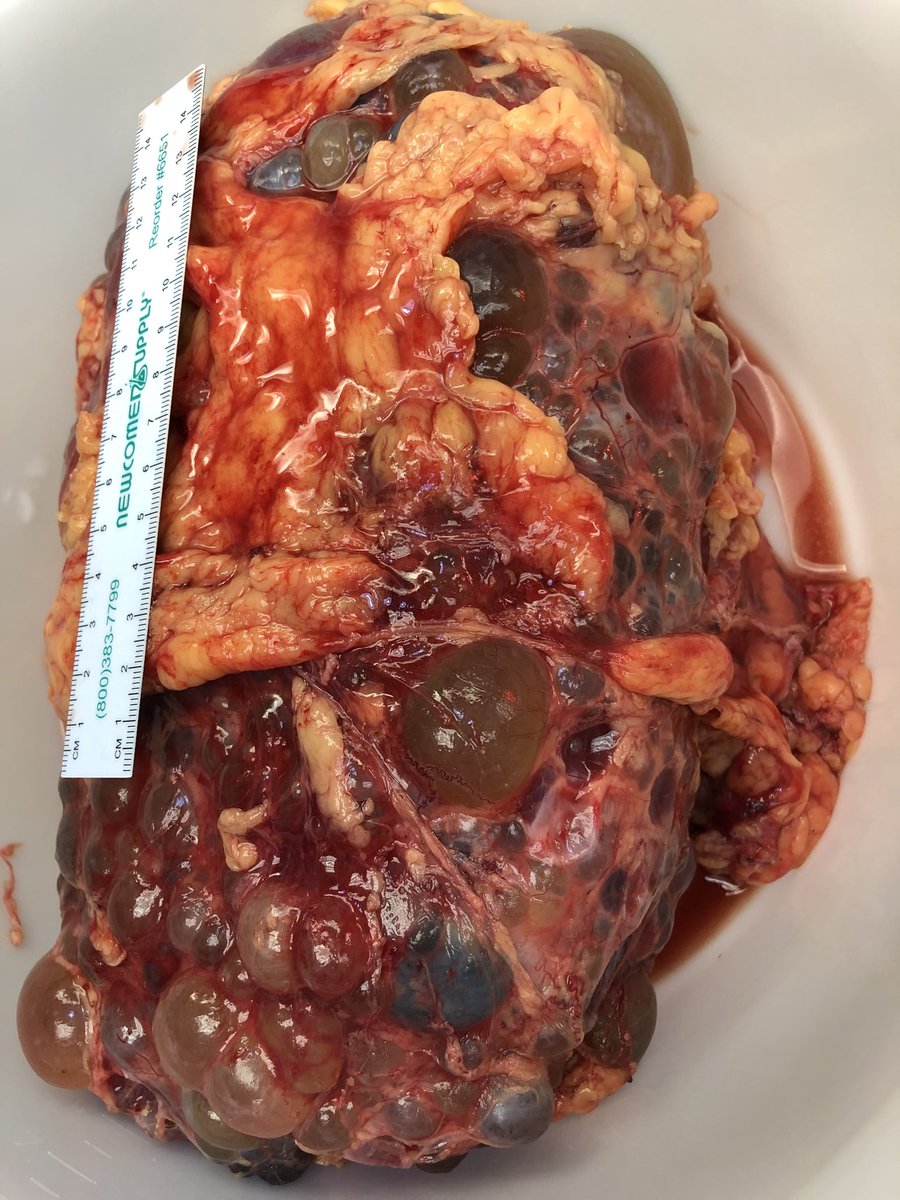 A polycystic kidney for your mid week viewing pleasure, lol #grosspath #pathology.