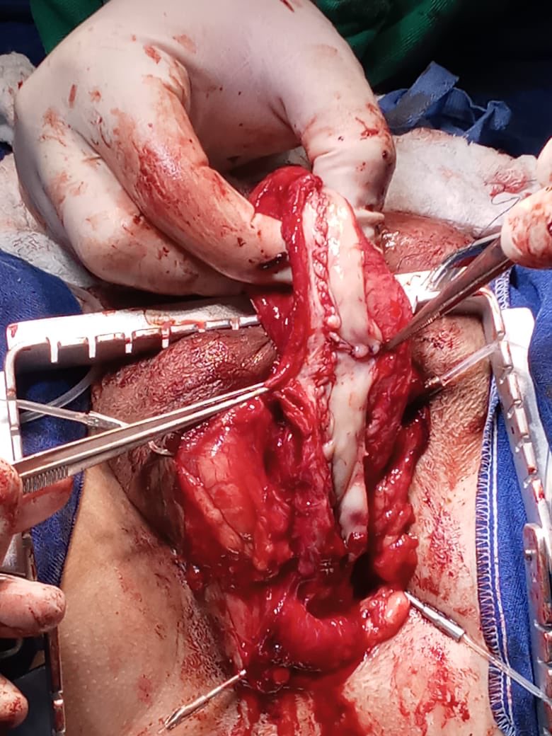 MarcoAu1957's tweet photo. One‐sided anterior urethroplasty with buccal graft (Kulkarni technique).  A 44 yo with an iatrogenic pan urethral stricture after a catheterization 3 years previously. Congrats @felipekasuya e @MauroBo89802655 https://t.co/yxGPVF4ceY
