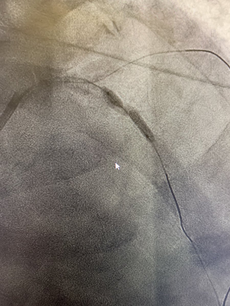 What would u do? 3 mm NC balloon at 30 ATM after 5 runs of CSI and angiosculpt balloon