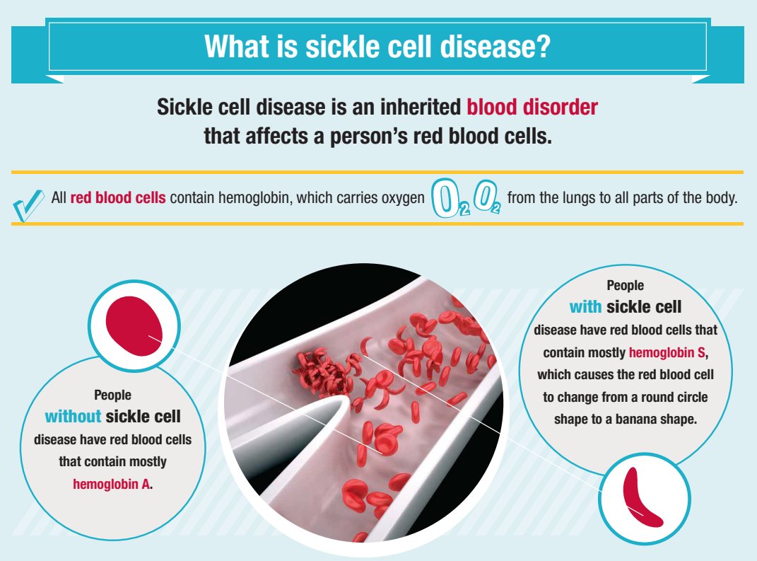 St. Jude Research on X: People with sickle cell disease have red blood  cells that contain mostly hemoglobin S, which causes the red blood cells to  change from a round circle shape