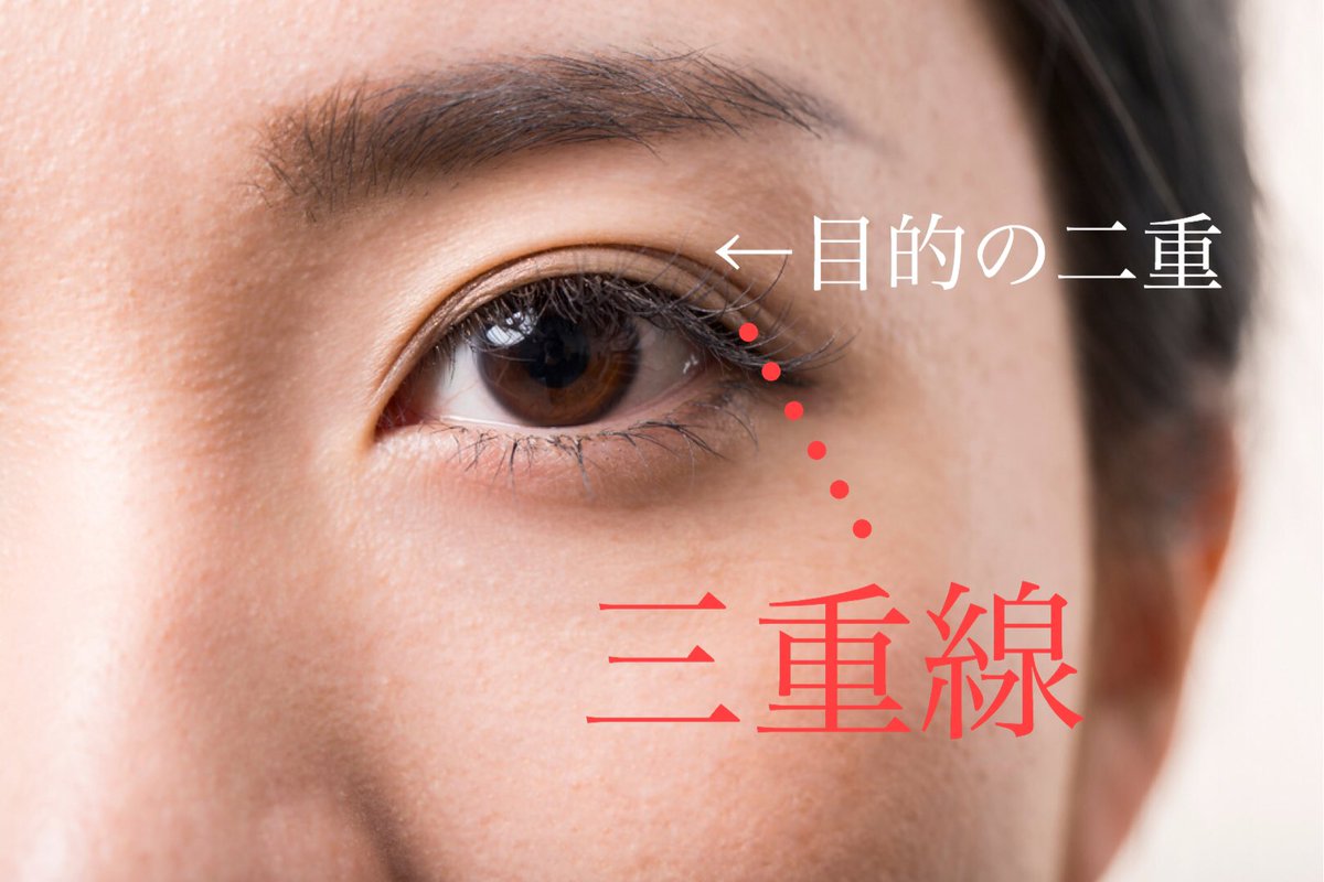 二重整形の名医相談窓口 目整形 埋没法 全切開 目頭切開 眉下切開 眼瞼下垂の失敗や修正 二重整形後にしばしば予定外重瞼線 三重が生じてしまうケースがある 2枚目 これらは眼瞼下垂 たるみ アイプチなどの癖 蒙古襞などが原因になる 綺麗な