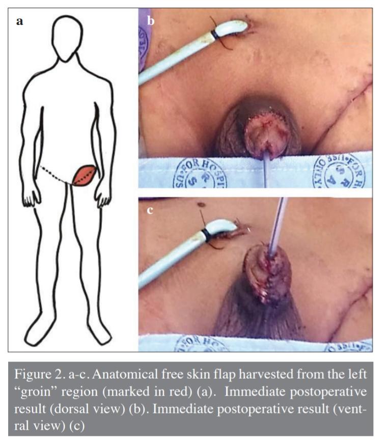 TurkJUrol's tweet photo. First report of successful refashioning using the Bracka technique after complete glans penile amputation from a dog bite injury in a child
#dogbite #penileamputation #urology #UroSoMe
@Akram0553 @Uroweb @AmerUrological @ESPUorg
Article link:
https://t.co/xKbp7GDGwU https://t.co/XggPnodelM