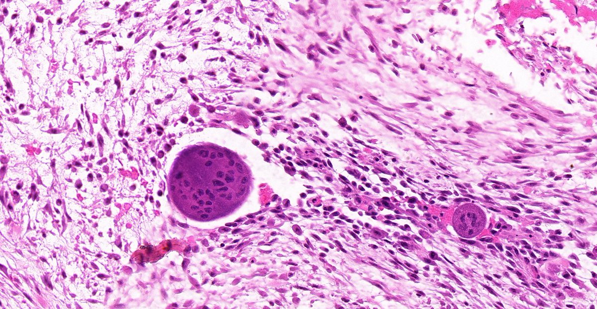 8/ But also can have: Numerous mitoses Scattered giant cells Focal metaplastic bone formation (relationship to MO) Centripetally oriented capillaries Cystic change