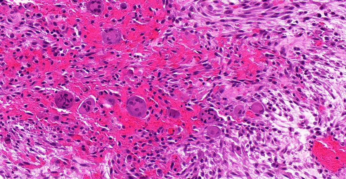 8/ But also can have: Numerous mitoses Scattered giant cells Focal metaplastic bone formation (relationship to MO) Centripetally oriented capillaries Cystic change