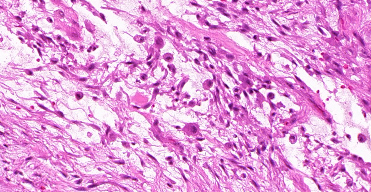 8/ But also can have: Numerous mitoses Scattered giant cells Focal metaplastic bone formation (relationship to MO) Centripetally oriented capillaries Cystic change