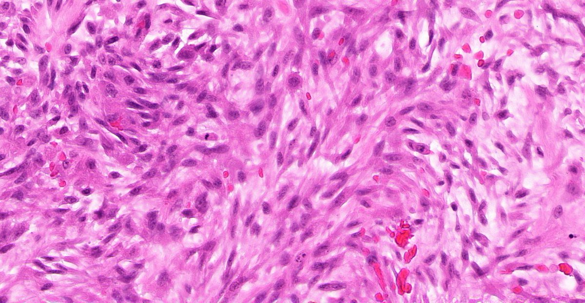 8/ But also can have: Numerous mitoses Scattered giant cells Focal metaplastic bone formation (relationship to MO) Centripetally oriented capillaries Cystic change