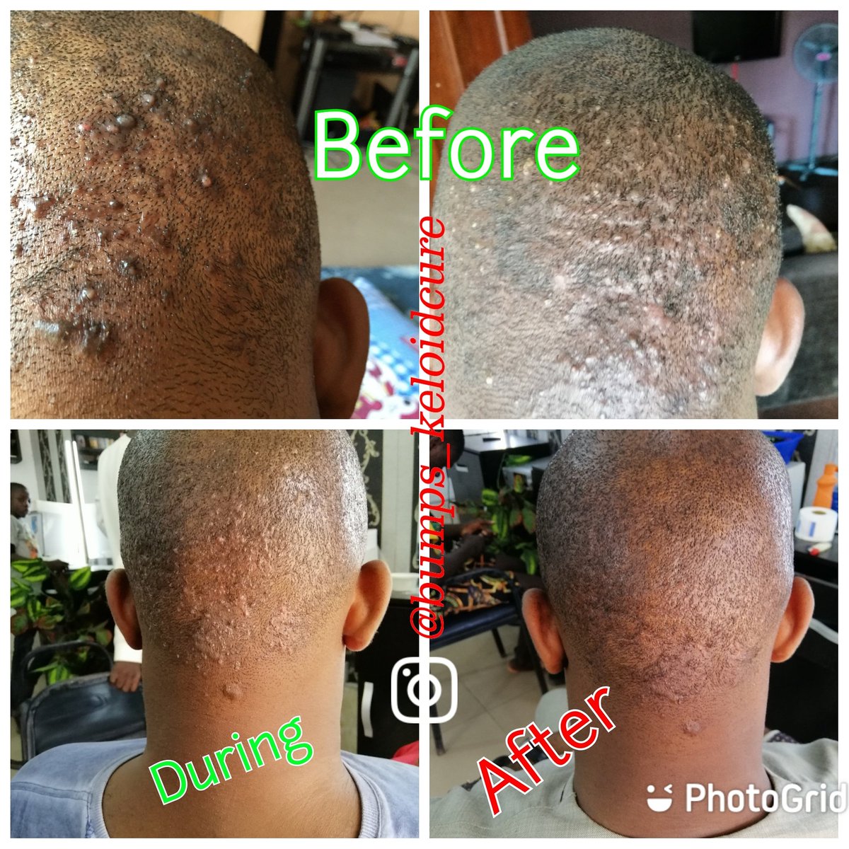 Bumps Keloid Treatment Bumpskeloid Twitter