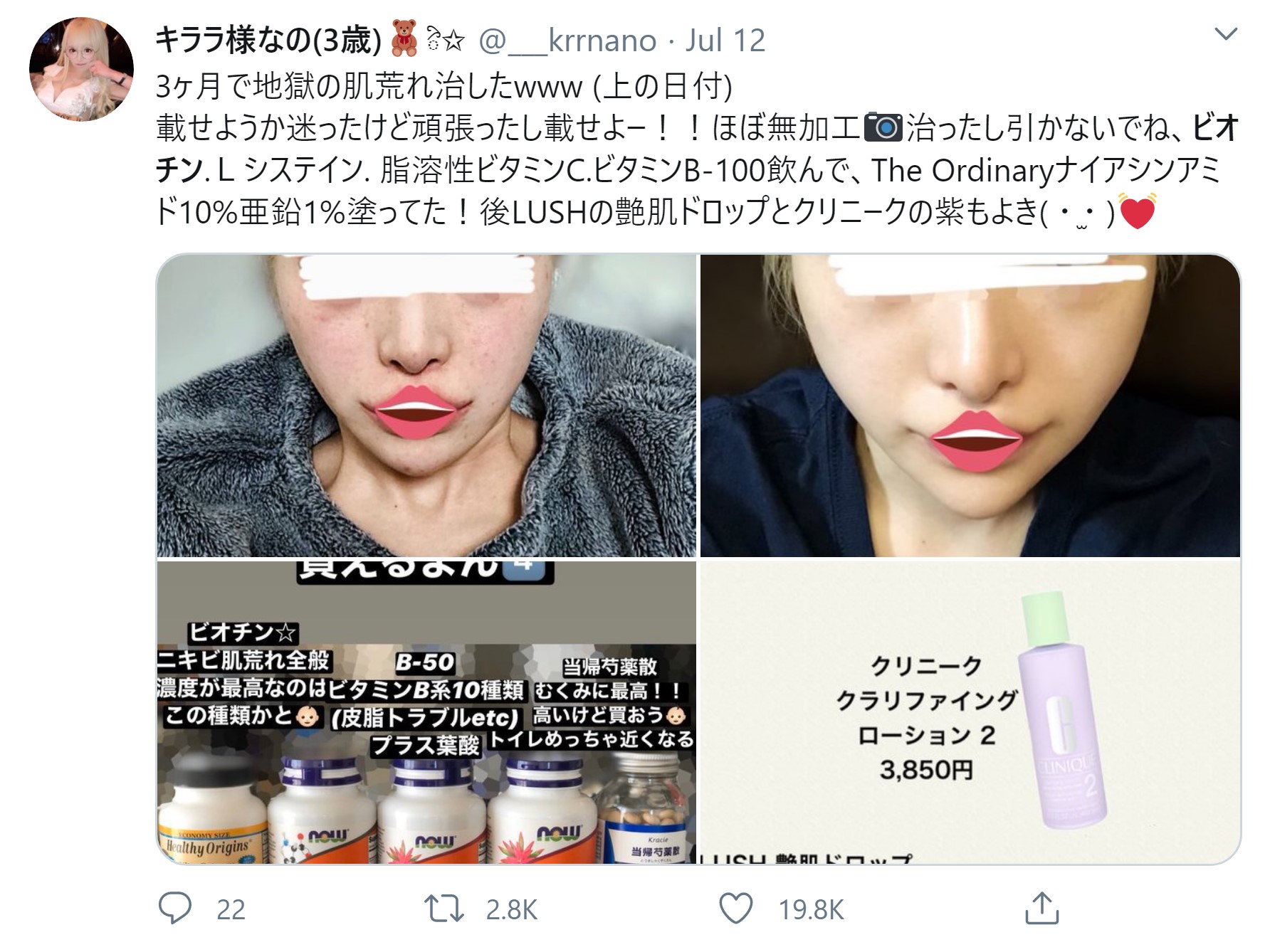 やさしい皮膚科医 美容インフルエンサー達が 肌や髪に良い とビオチンサプリを宣伝しますが 実際には臨床試験で効果が示された事は一度も無いです 逆に ビオチンサプリを飲んでいる人では 白髪が多い やさしい皮膚科医 美容インフルエンサー達が 肌や髪に良い とビオチンサプリを宣伝しますが 実際には臨床試験で効果が示された事は一度も無いです 逆に ビオチンサプリを飲んでいる人では 白髪が多い