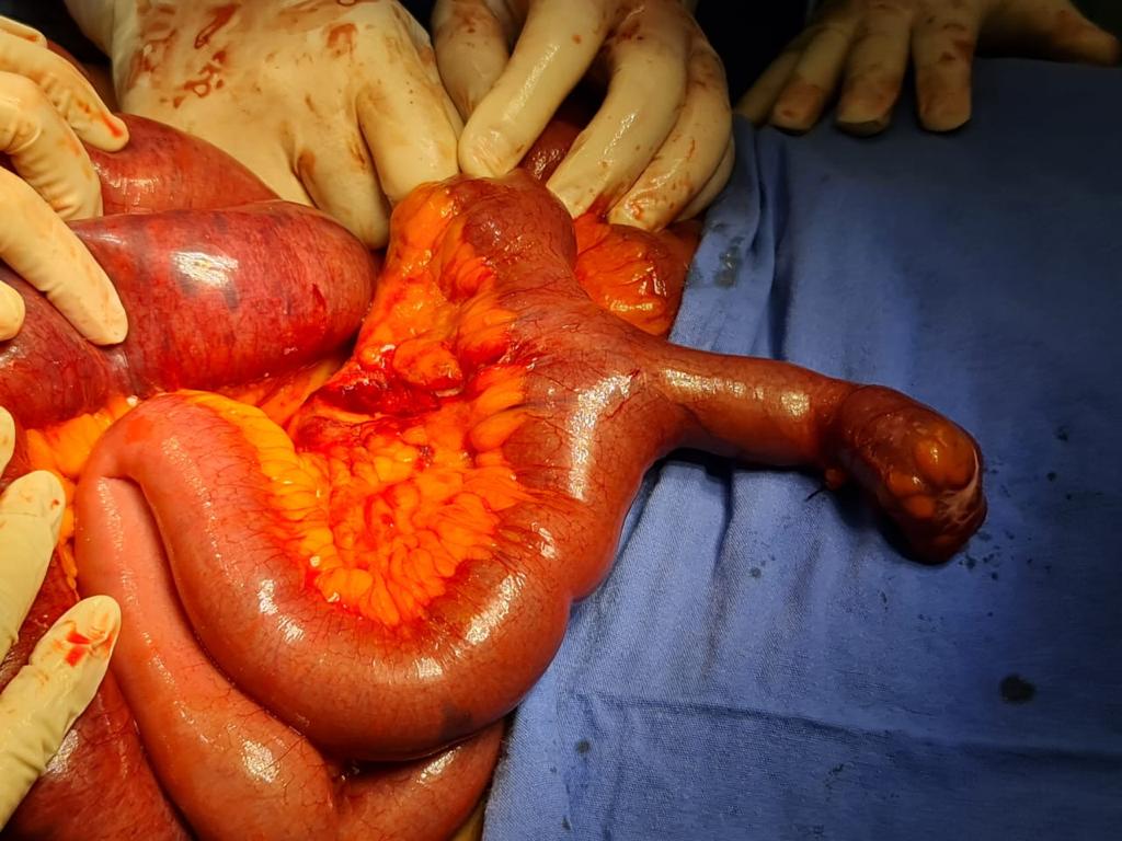ElCirugia's tweet photo. Oclusión intestinal por Diverticulo de Meckel estrangulado #diverticulo https://t.co/pkYln4VKhx