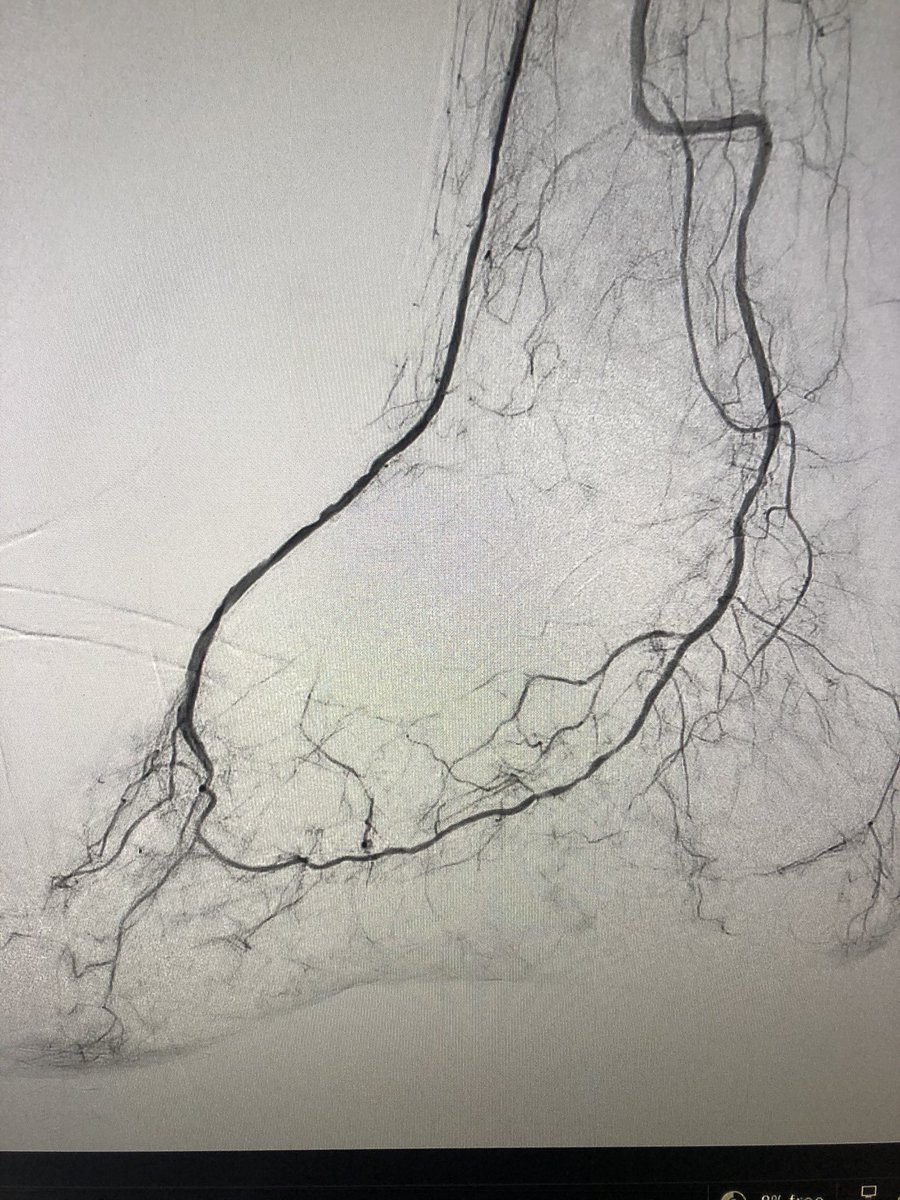Andrew Niekamp (@andrewniekampmd) on Twitter photo Patient with R5 #CLI of right forefoot. Single vessel supply via peroneal. AT occluded throughout. Successful anterograde recan of AT & DP now with intact pedal arch. Now the watch and wait for the most important part: wound healing <a href="/MiamiVasc/">Miami Vascular</a> <a href="/AlexPowellMD1/">Alex Powell,MD</a> @brianjschiromd Patient with R5 #CLI of right forefoot. Single vessel supply via peroneal. AT occluded throughout. Successful anterograde recan of AT & DP now with intact pedal arch. Now the watch and wait for the most important part: wound healing <a href="/MiamiVasc/">Miami Vascular</a> <a href="/AlexPowellMD1/">Alex Powell,MD</a> @brianjschiromd