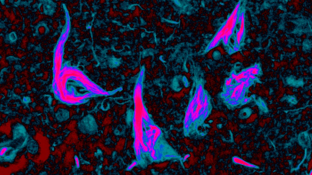 Vacuolar Tauopathy. Our paper in @sciencemagazine describes a novel hereditary #FrontotemporalDementia with hypomorph VCP mutation ➝ loss of tau disaggregase function.

dx.doi.org/10.1126/scienc…