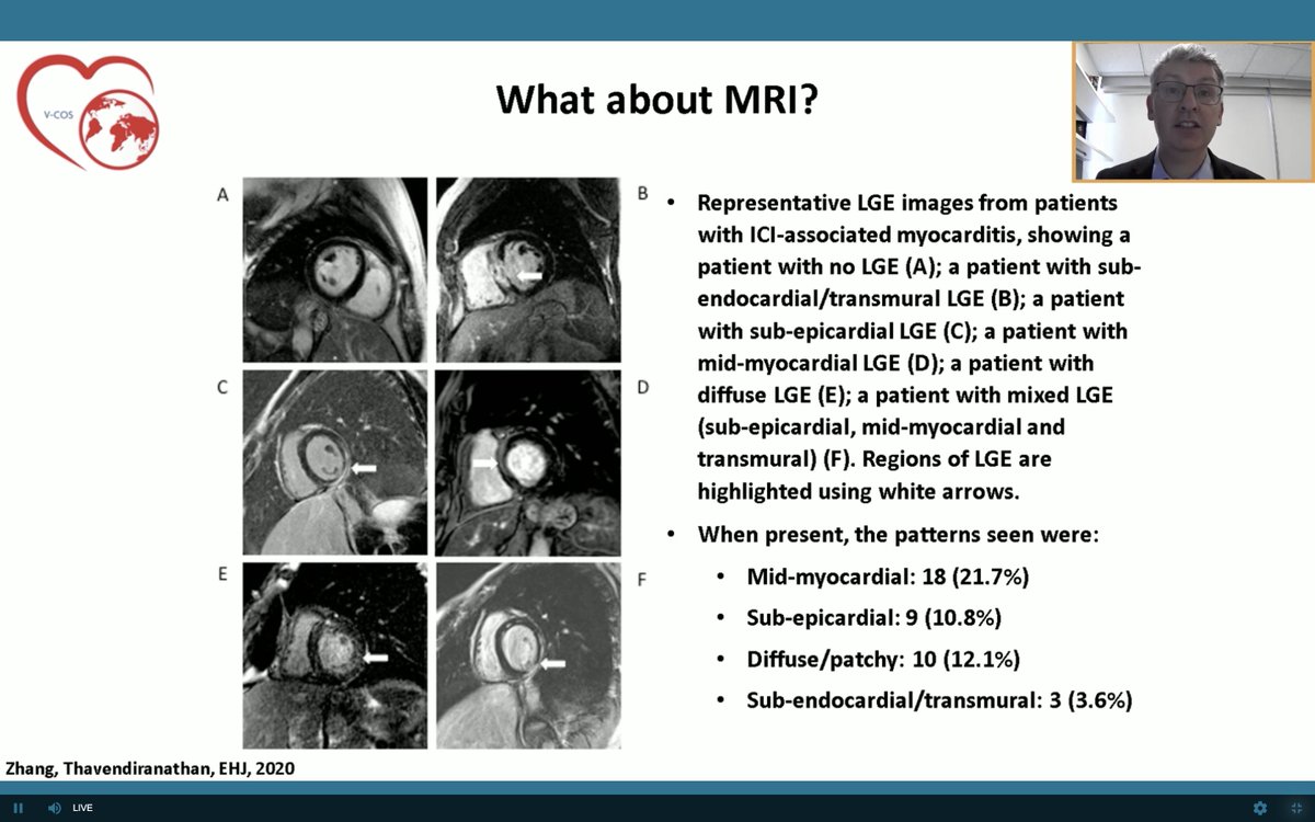 datsunian's tweet image. @MGHHeartHealth #cardioonc guru @TomasNeilan presents the unknown &amp;amp; knowns (thanks 2 Tom) on our evolving understanding of ICI myocarditis at #vcos2020. Critical to further our research efforts on dx &amp;amp; tx strategies to recognize and treat this highly fatal &amp;amp; new disease state.