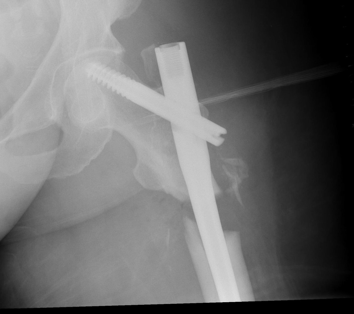 [1/11] JBJS March 2009: classic instructional course lecture titled: “intertrochanteric fractures: t...