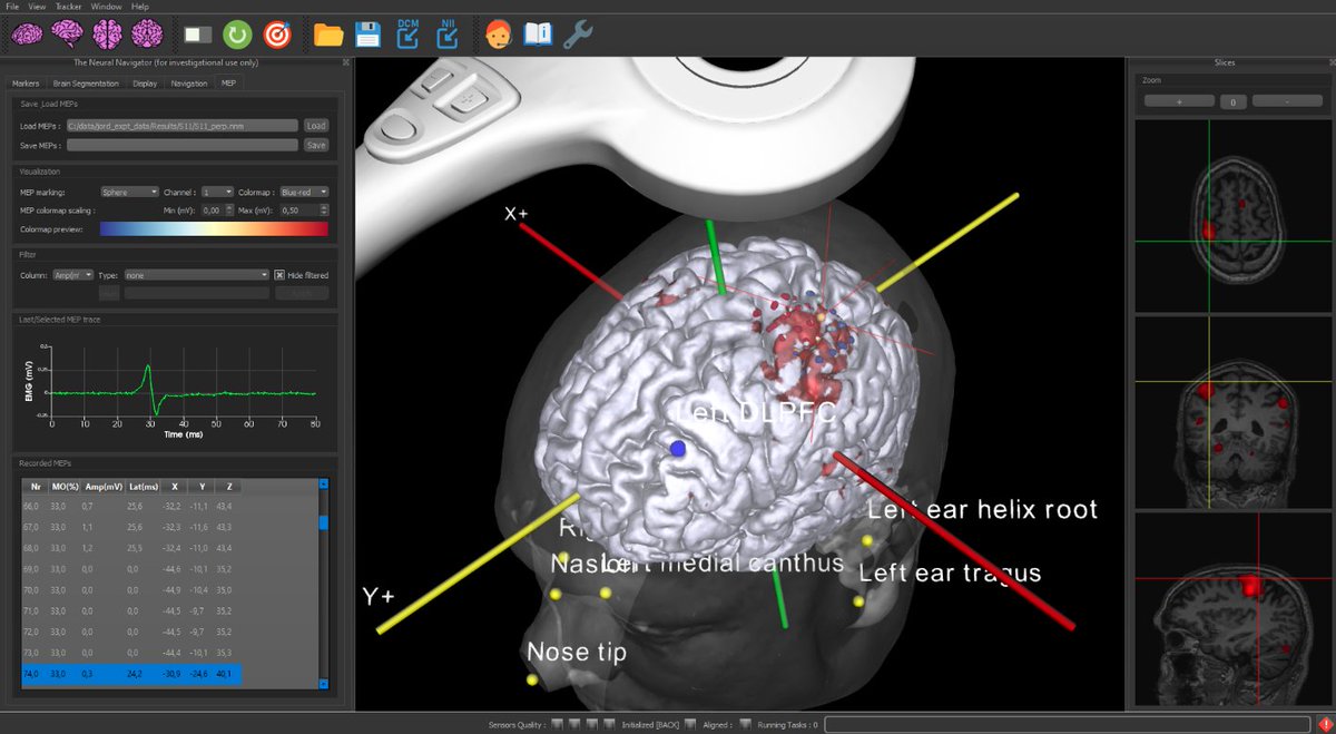 SoterixMedical's tweet photo. Neural Navigator is a true neuronavigation solution that uses MRI scans as opposed to tracking TMS coil with respect to a model head. Neural Navigator is the first and only neuronavigation system that is not affected by line-of-sight occlusion #neuronavigation #TMS #rTMS https://t.co/iagJ9FRXQ6