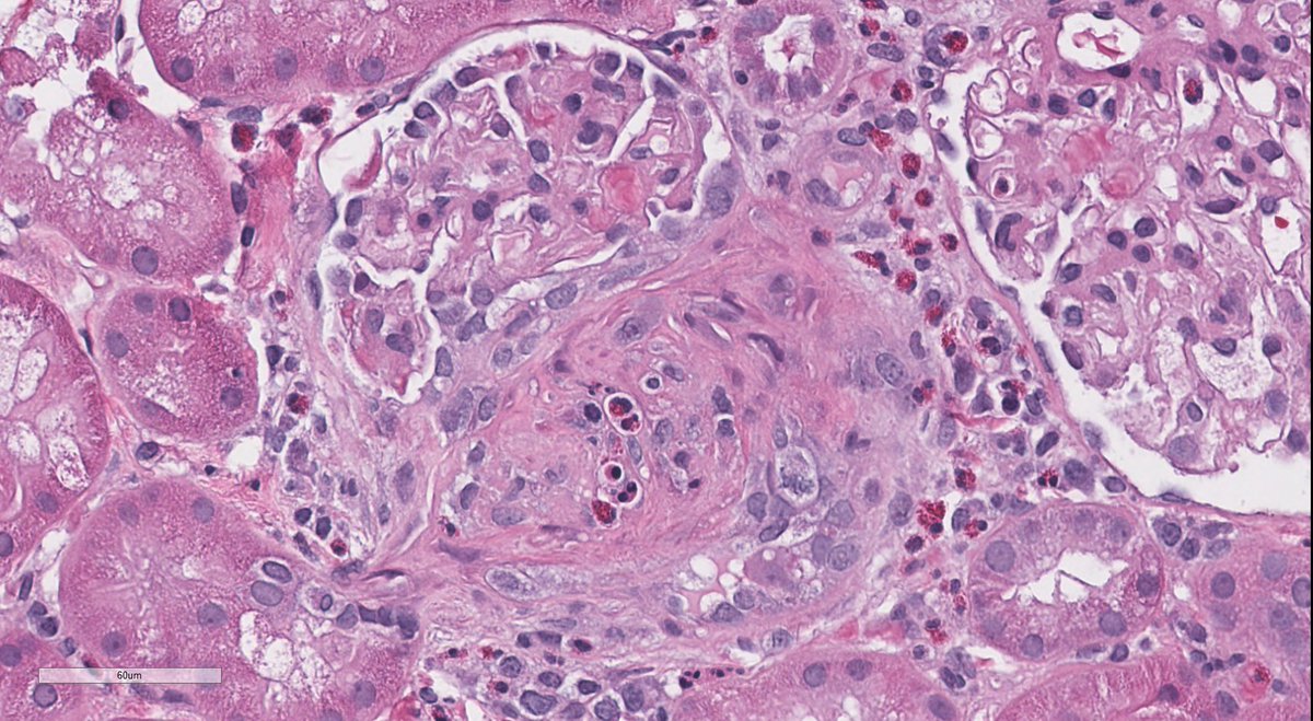 JZRenalPath's tweet image. Older patient with AKI, asthma, and eosinophilia. Bx with pauci-immune necrotizing/crescentic GN. Eosinophils everywhere. Clinical diagnosis is EGPA. #renalpath